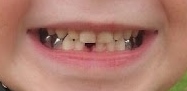 lost tooth - Artie Feb 13 16